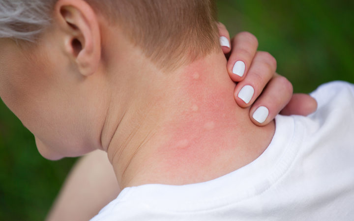 Girl with blond hair, sitting with his back turned and scratching bitten, red, swollen neck skin from mosquito bites in the summer in the forest.  Close-up up of visible insect bites. Irritated skin.