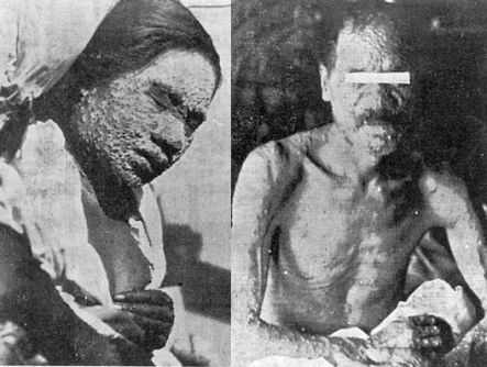 Small Pox Victims